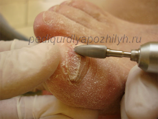 Ногти во время процедуры аппаратной чистки